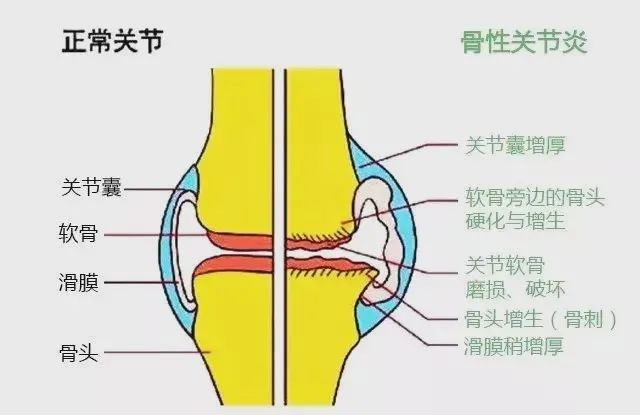 强力运动时容易损伤半月板,甚至撕裂,尤其是膝关节突然旋转变向时极易
