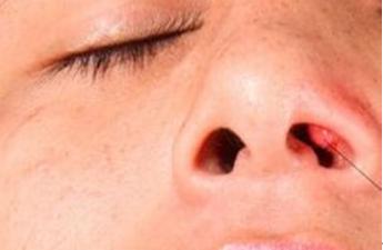 以为是鼻涕结果是脑脊液孩子的鼻涕没那么简单
