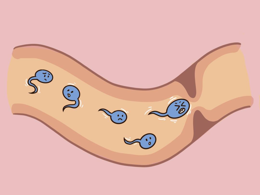 梗阻性无精症因此根据该诊断,通过取精术及辅助生殖技术,使这对夫妇