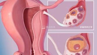查出卵巢囊肿，是否会癌变？