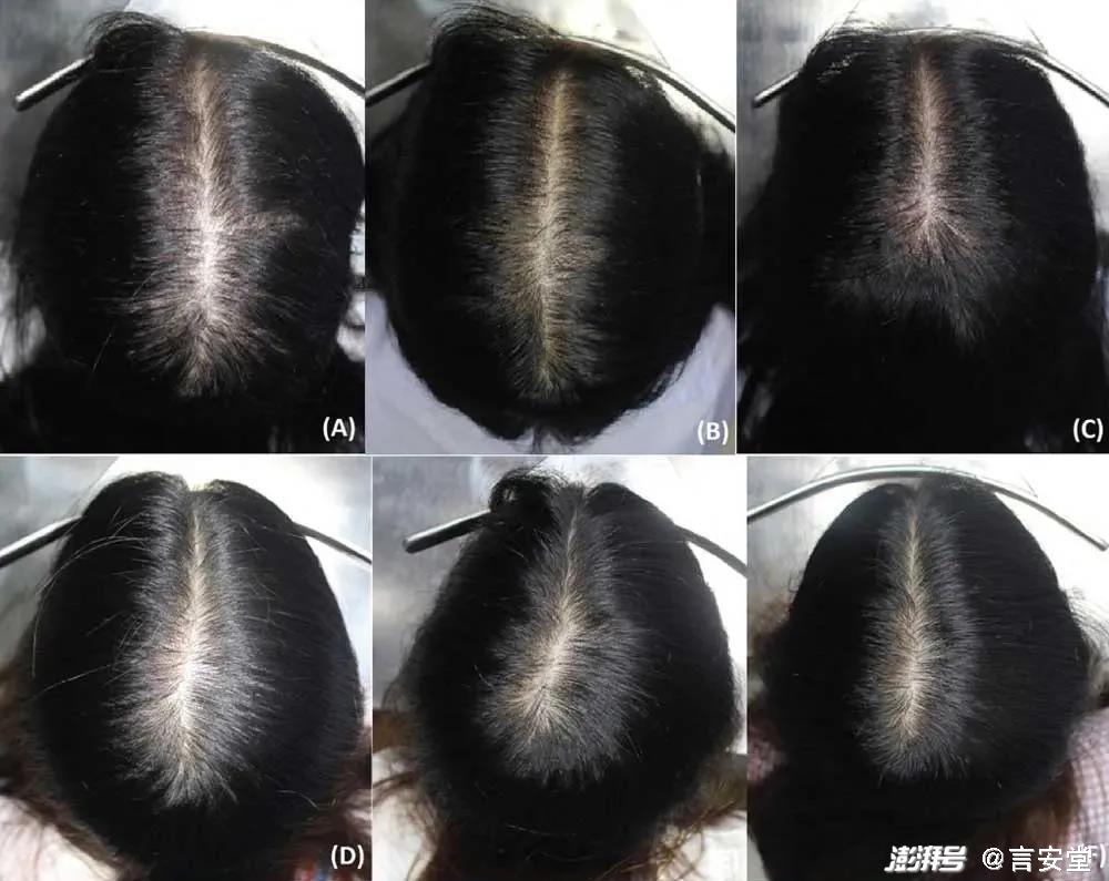 5亿人存在脱发问题,拯救脱发只能靠植发了吗?