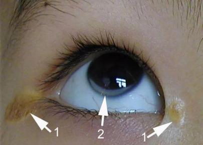 要命的高胆固醇血症一次帮你全讲清