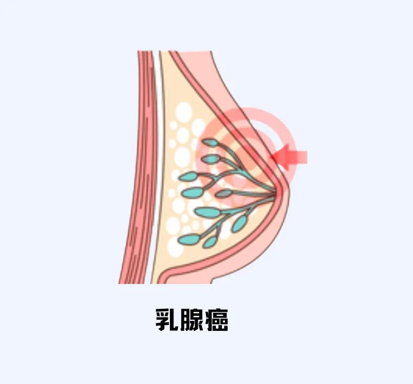 体检发现"肿瘤标志物"升高,该怎么办?