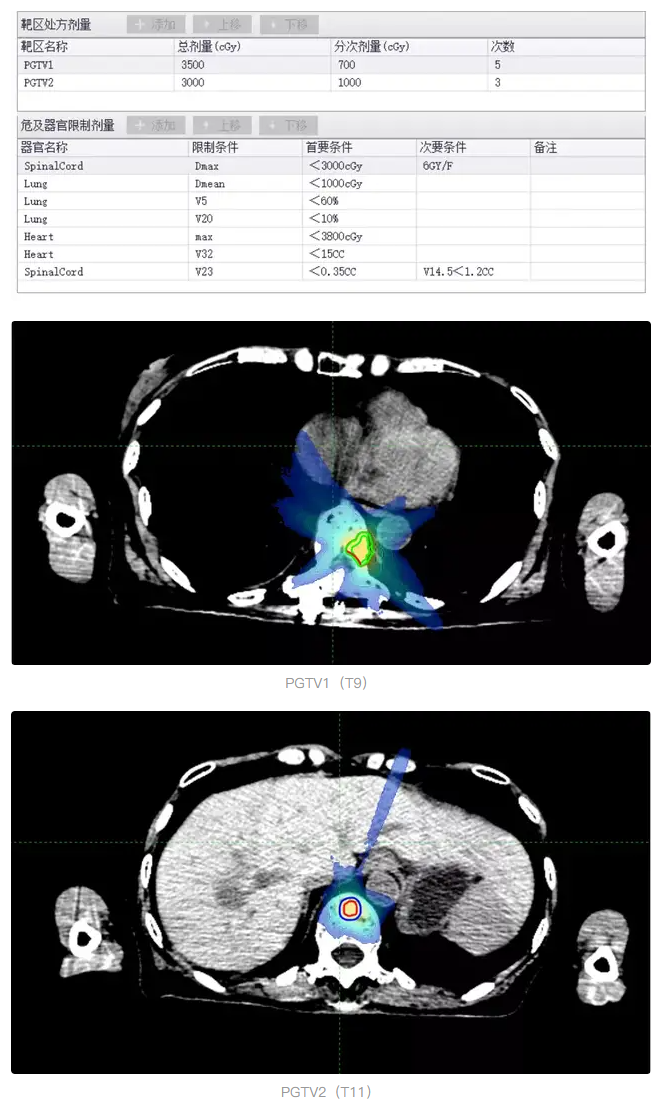 華東首秀!m6型射波刀落戶國科大腫瘤醫院