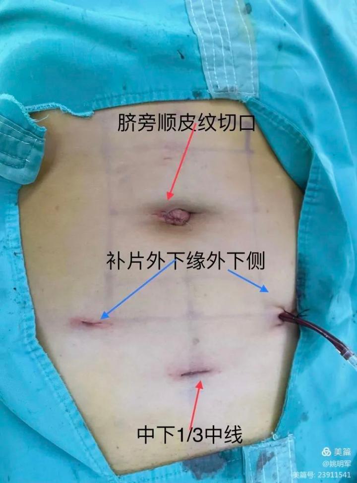 疝补片是什么医学“愚公”搬“疝”记——看专业团队如何移掉患者身上的三座大“疝”_https://www.jmylbn.com_新闻资讯_第1张