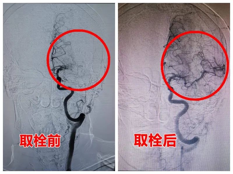 取栓治療共分為以下四步1微導管進入閉塞血管2支架通過微導管到達血栓