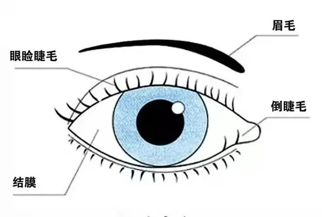 有倒睫毛,该拔掉还是做手术人的睫毛通常是向前向上