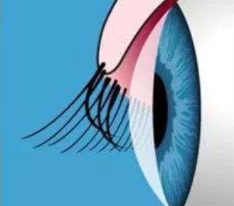 有倒睫毛该拔掉还是做手术