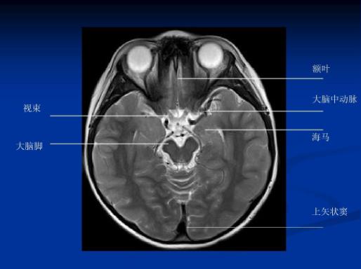核磁共振海马解剖图图片