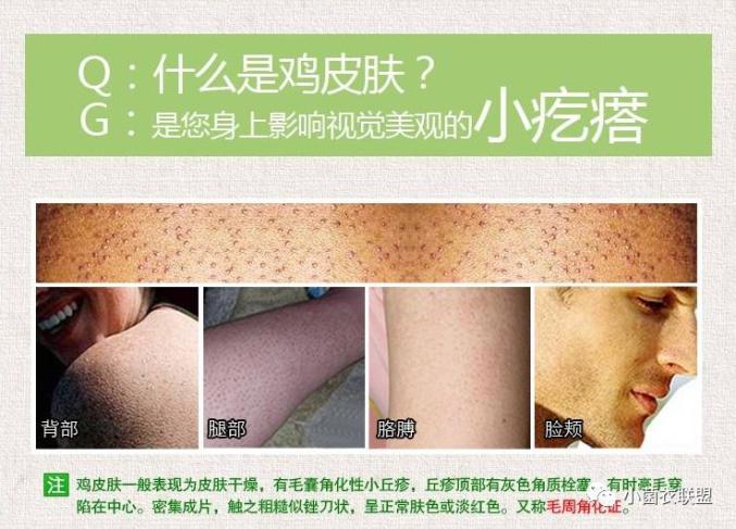腿上有鸡皮肤可以当空姐吗的简单介绍
