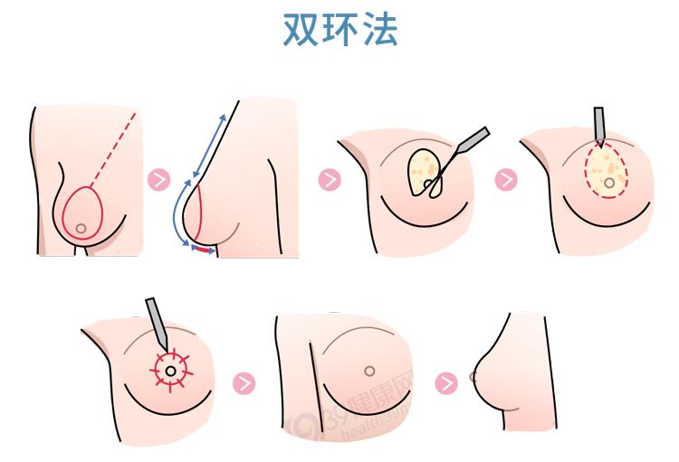 双环提升乳房手术步骤图片