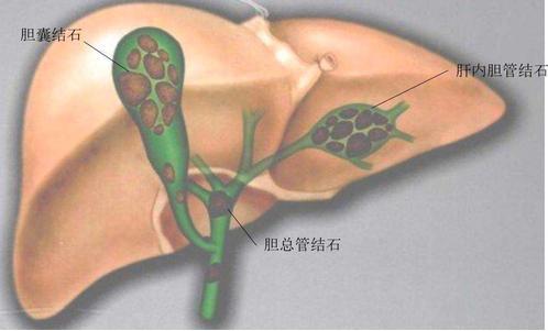 【浦人医·健康】健康知识月月讲之胆道结石的微创治疗