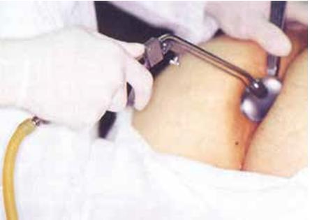 一次性肛门镜怎么检查结直肠肛门疾病的诊断——体格检查_https://www.jmylbn.com_新闻资讯_第10张