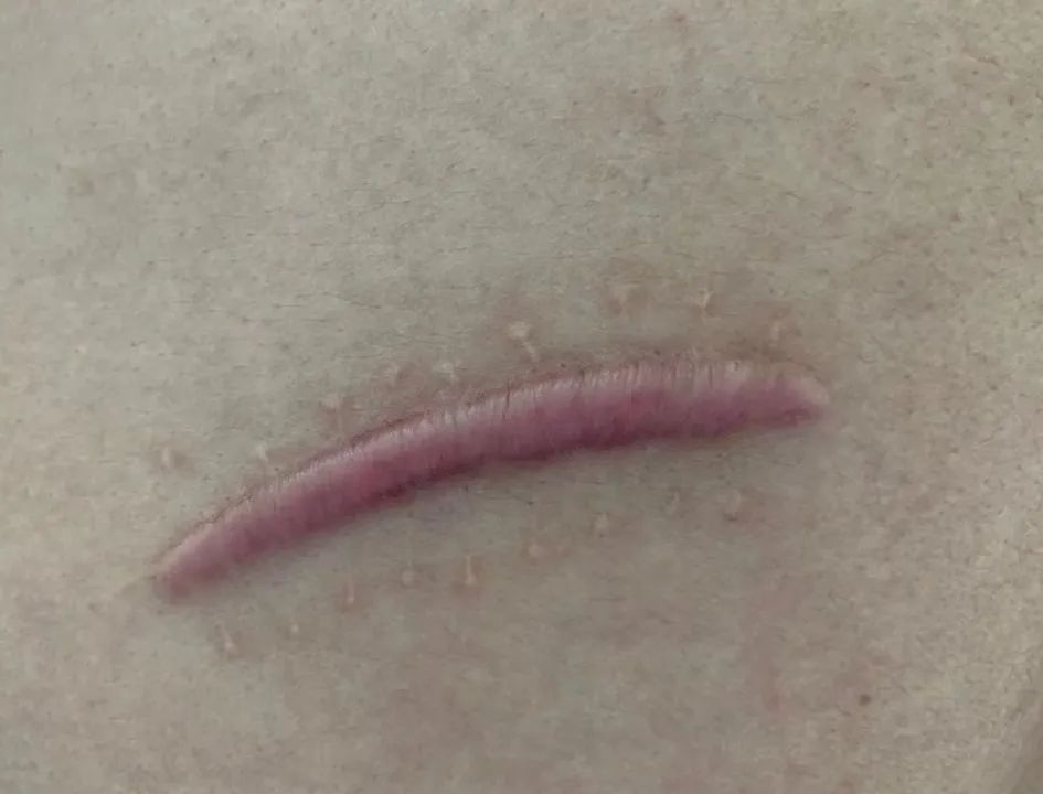 疤痕也会癌变么?