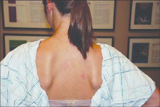 女生后背肩胛骨酸胀图片