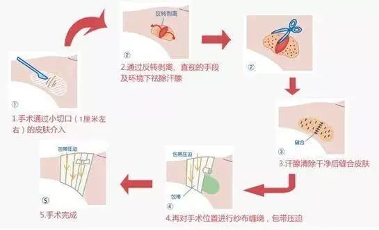 小切口腋臭手术图解图片