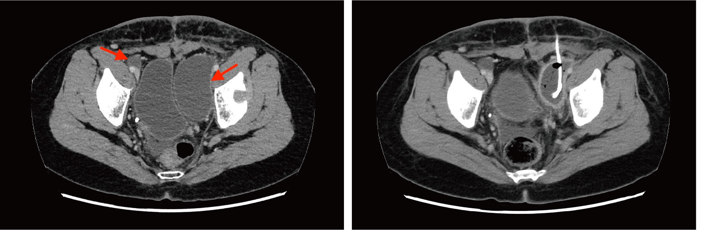 左图红色箭头所示为盆腔双侧髂血管旁包裹积液，右图为引流术后1个月CT图像