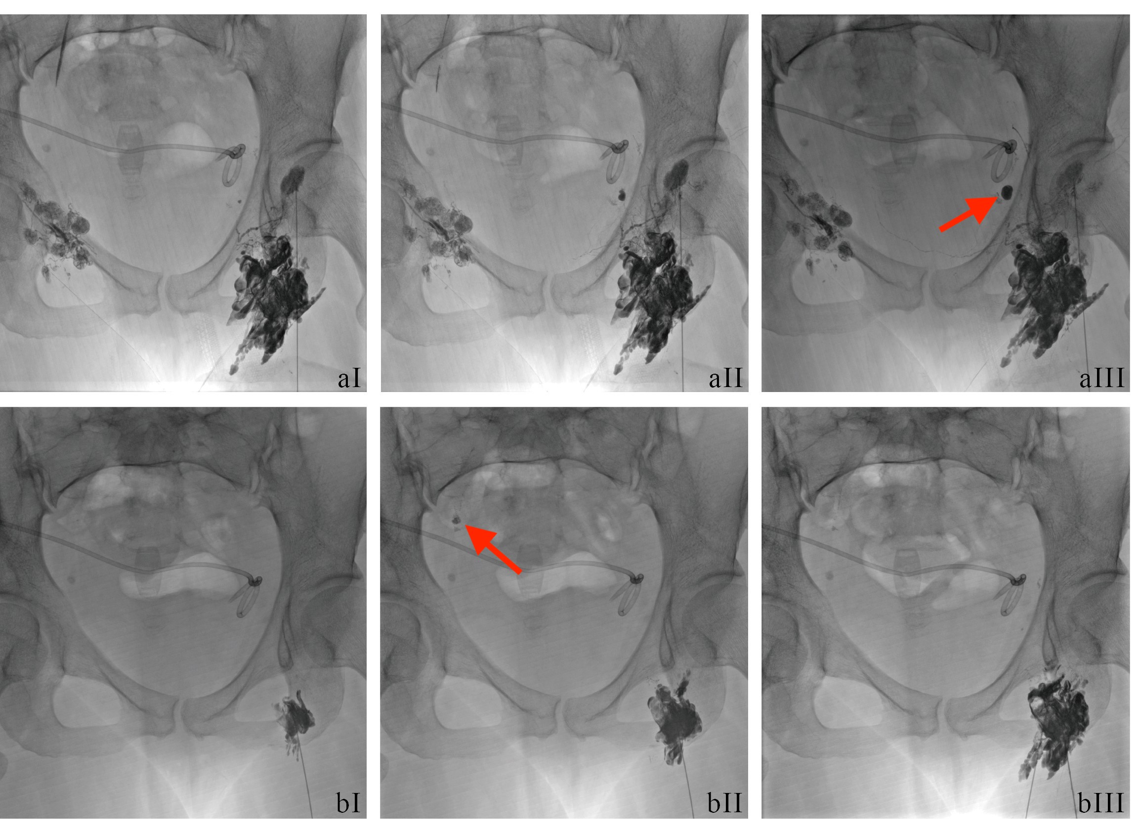 图aI-aIII、bI-bIII分别为左侧、右侧盆腔淋巴管瘘点显影过程，红色箭头所指为漏点
