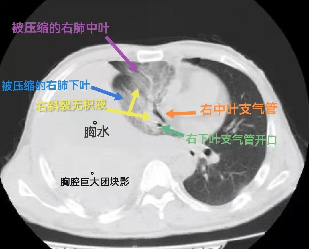 而且從片上可看到胸水將右肺下葉往前縱膈壓