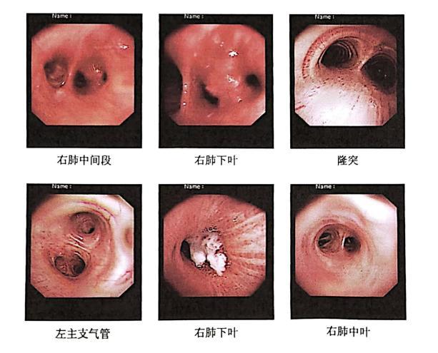 更微创,更精准!急救创伤中心胸外科肺癌手术进入新时代