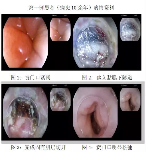 消化內科完成兩例賁門失弛緩症困難poem術