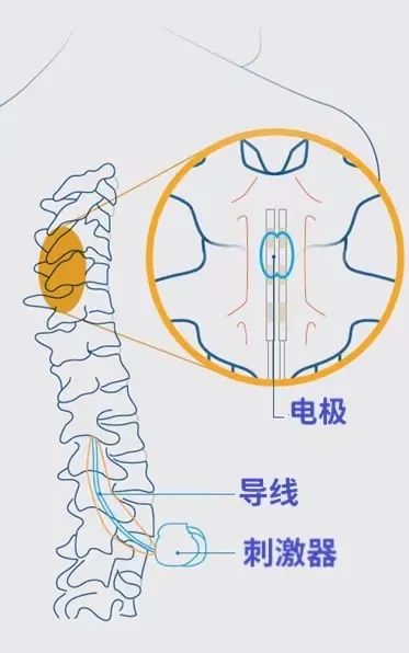 鎮痛起搏器助力患者減輕疼痛