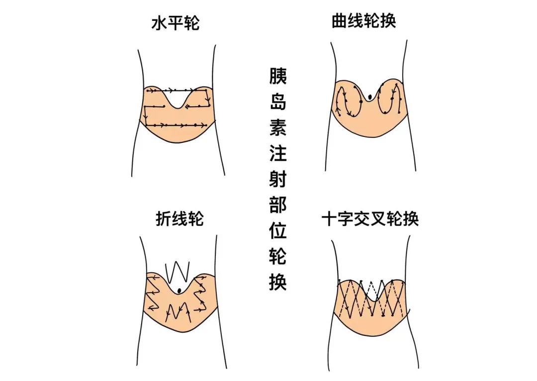 胰岛素注射腹部区域图图片