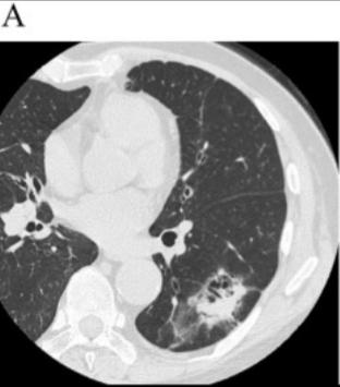 莲蓬征肺图片