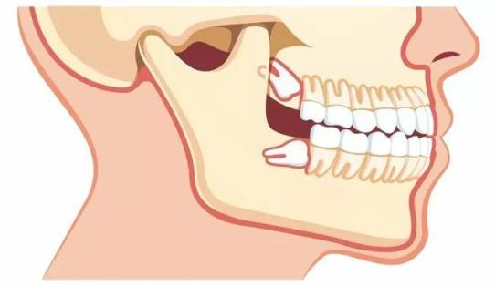 造成牙齦炎,冠周炎等口腔疾病被牙齦甚至骨組織包埋無處生長的智齒只