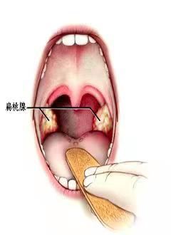 腭垂疼图片