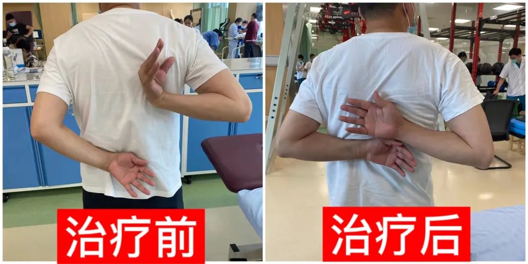 一例手外伤术后制动导致肩关节活动受限的案例