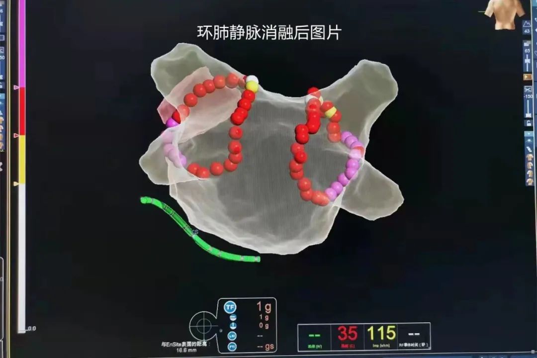 颠覆传统治疗,根治心脏"乱跳",摆脱终生服药!