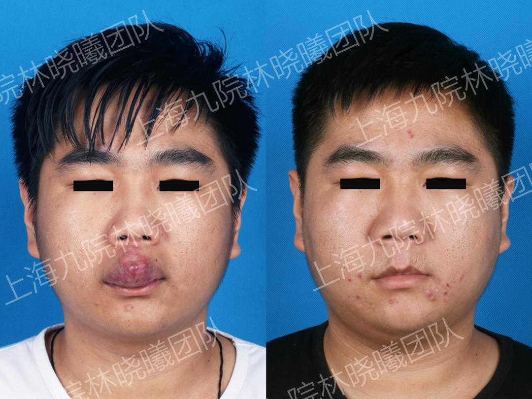 造影情况(下)术后标准照片及血管造影情况患者,男性,唇部动静脉畸形