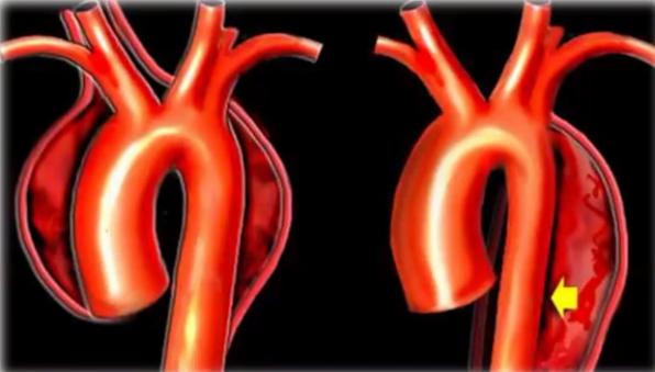 什么是动脉夹层的早期症状 779.jpg