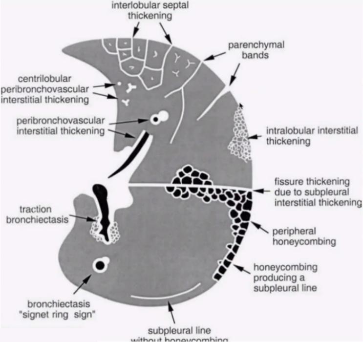 肺间质示意图图片