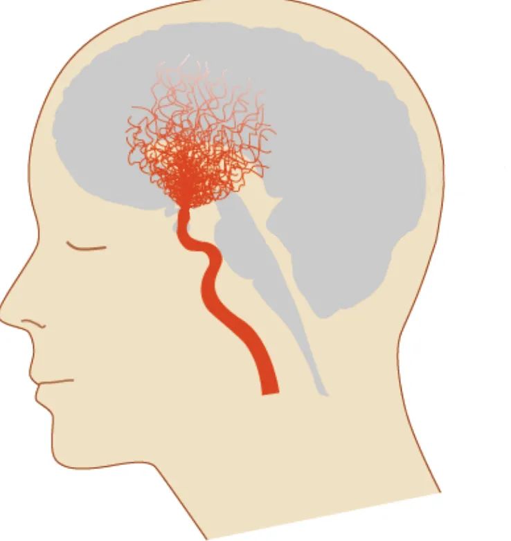 健康年紀輕輕反覆腦梗原因竟是