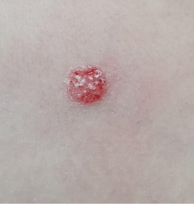 健康科普小孩也有牛皮癣