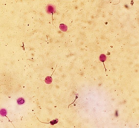 精子dna碎片率分析:是不育症患者,习惯性流产,胚胎停育患者的配偶,有