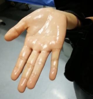 19岁女孩患手汗症手像被水洗过这种病年轻人高发