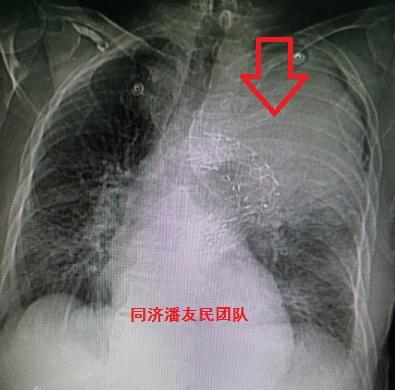 主动脉弓胸片图片