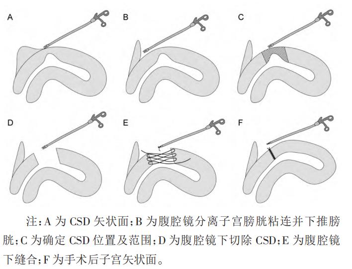 生过孩子的B 子宫口图片