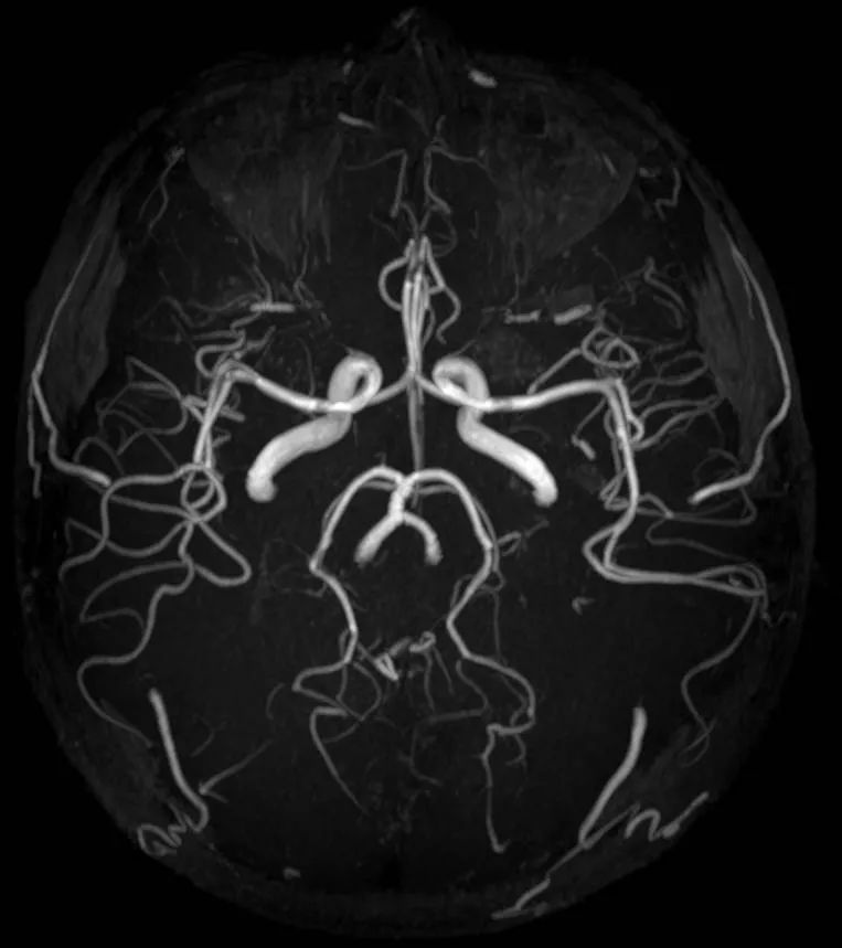 其中,因血流量大,呼吸运动伪影干扰少,头颅mra对颅脑和颈部的大血