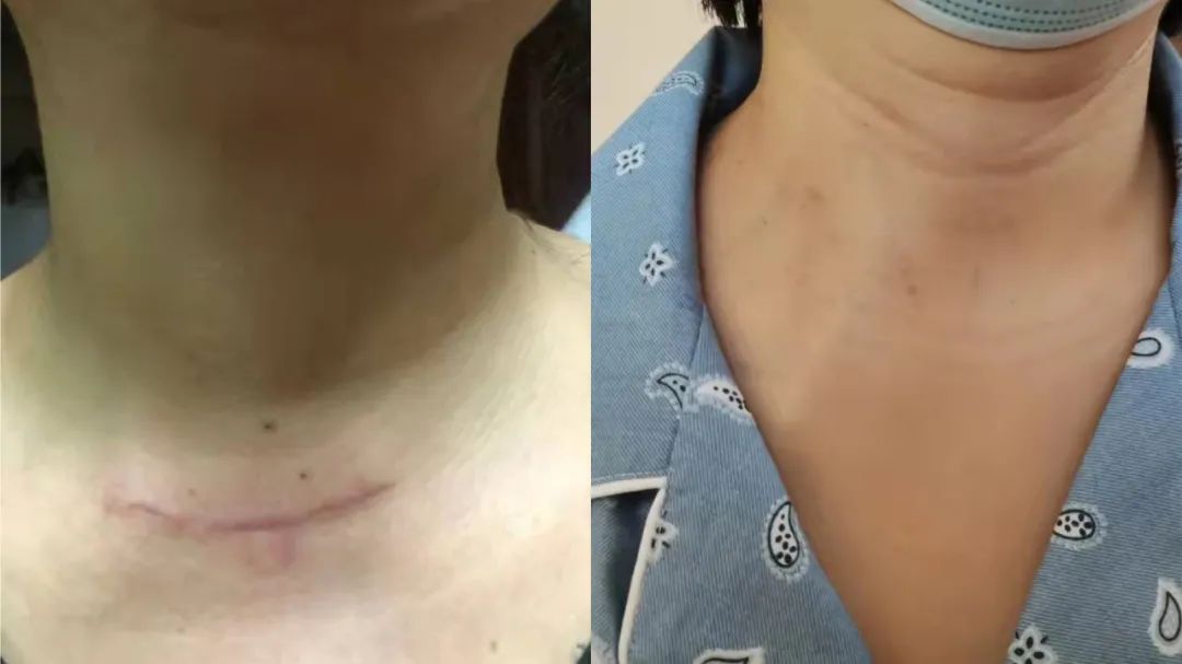 一女子甲状腺手术后,伤口竟然"隐形了"!