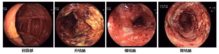 并可见多发大小不等的的不规则溃疡,部分溃疡深大;乙状结肠弥漫性充血