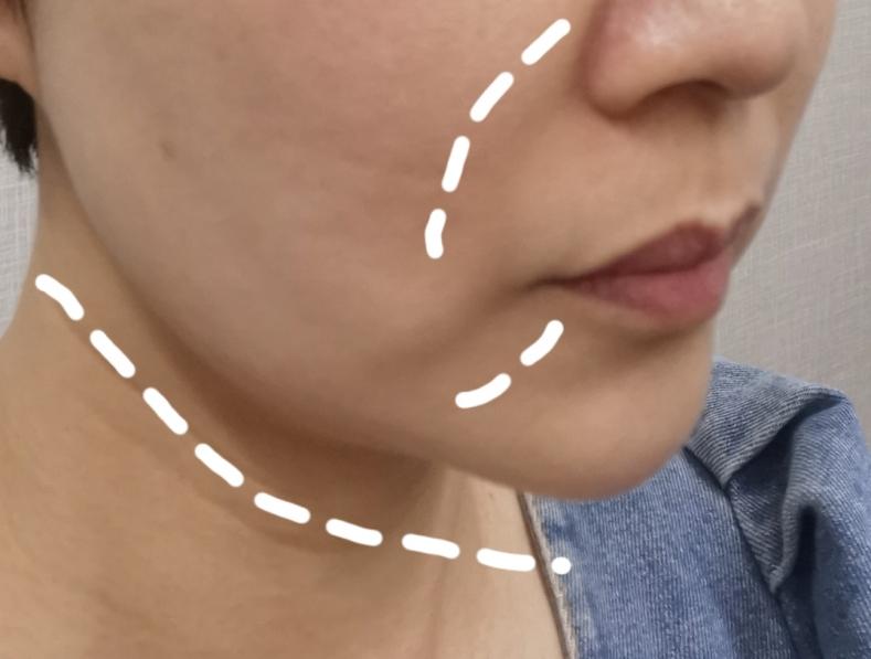 无痛提拉紧致黑科技终于等到你