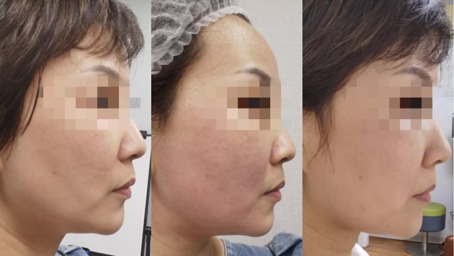 无痛提拉紧致黑科技终于等到你