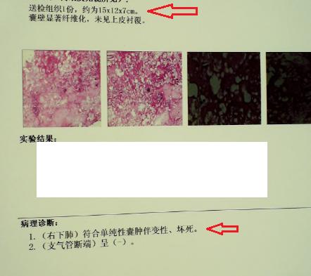 肺部畸胎瘤,巨大左心房,支气管囊肿,肺部淋巴管瘤,贴近胸膜的肺脓肿