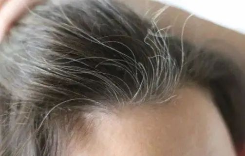 早生华发可能是缺乏这几种营养素