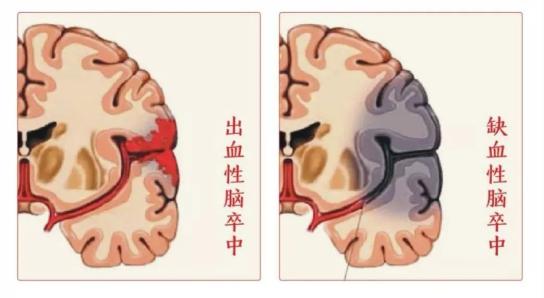 必看!中风有前兆,这些日常行为很危险!