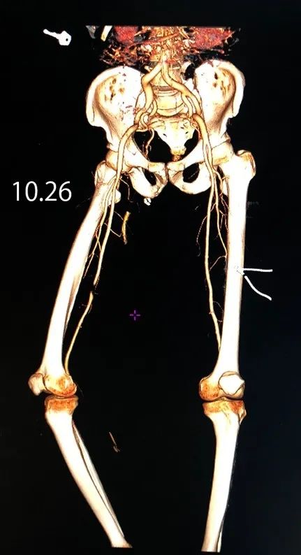 六院新闻我院援藏医生谢雪涛成功开展日喀则市首例股动脉破裂修复手术